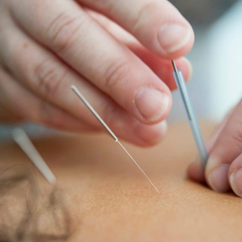 a woman getting acupuncture done for endometriosis