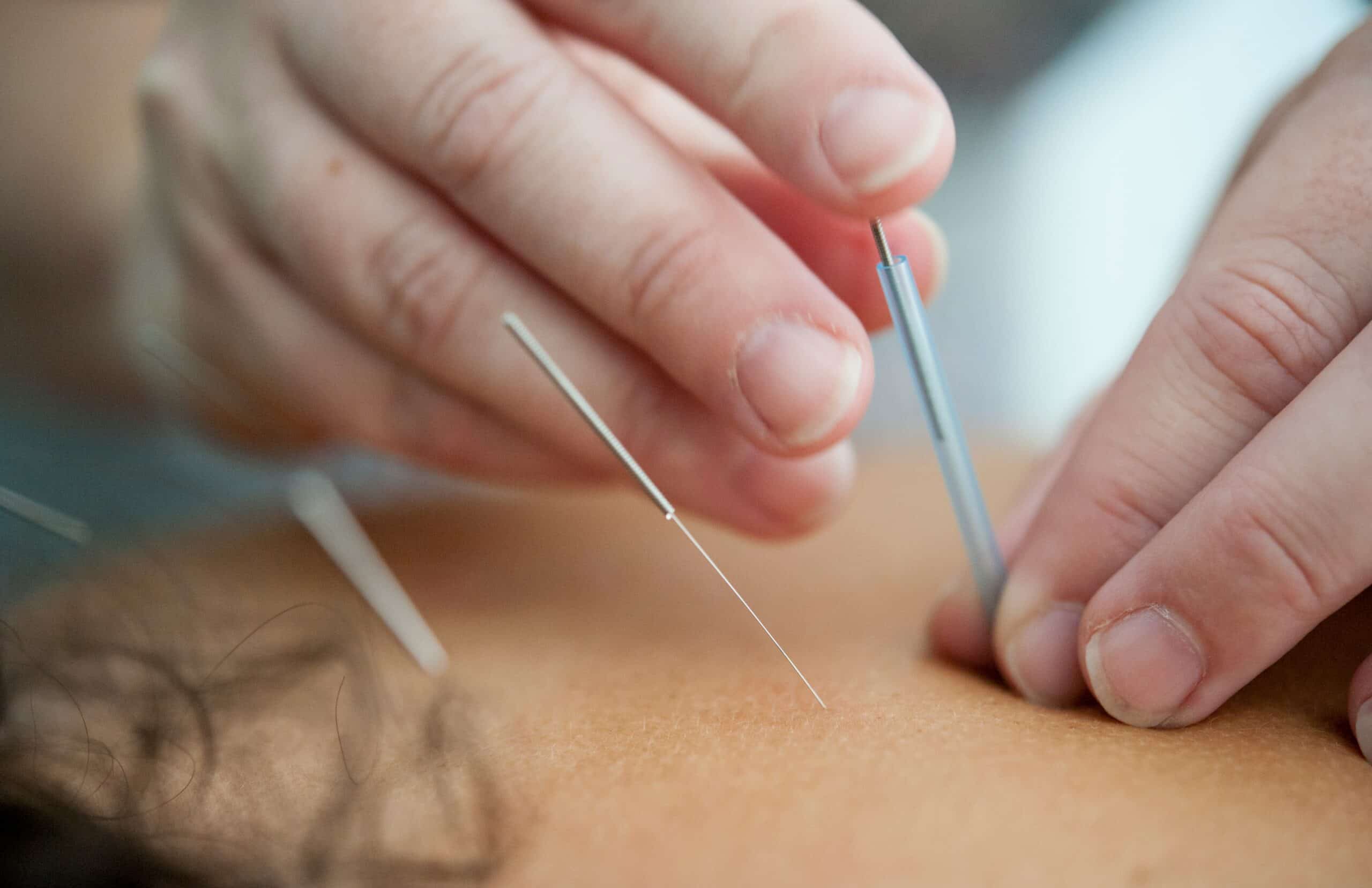 Can Acupuncture Help Endometriosis Pain? Benefits & Research