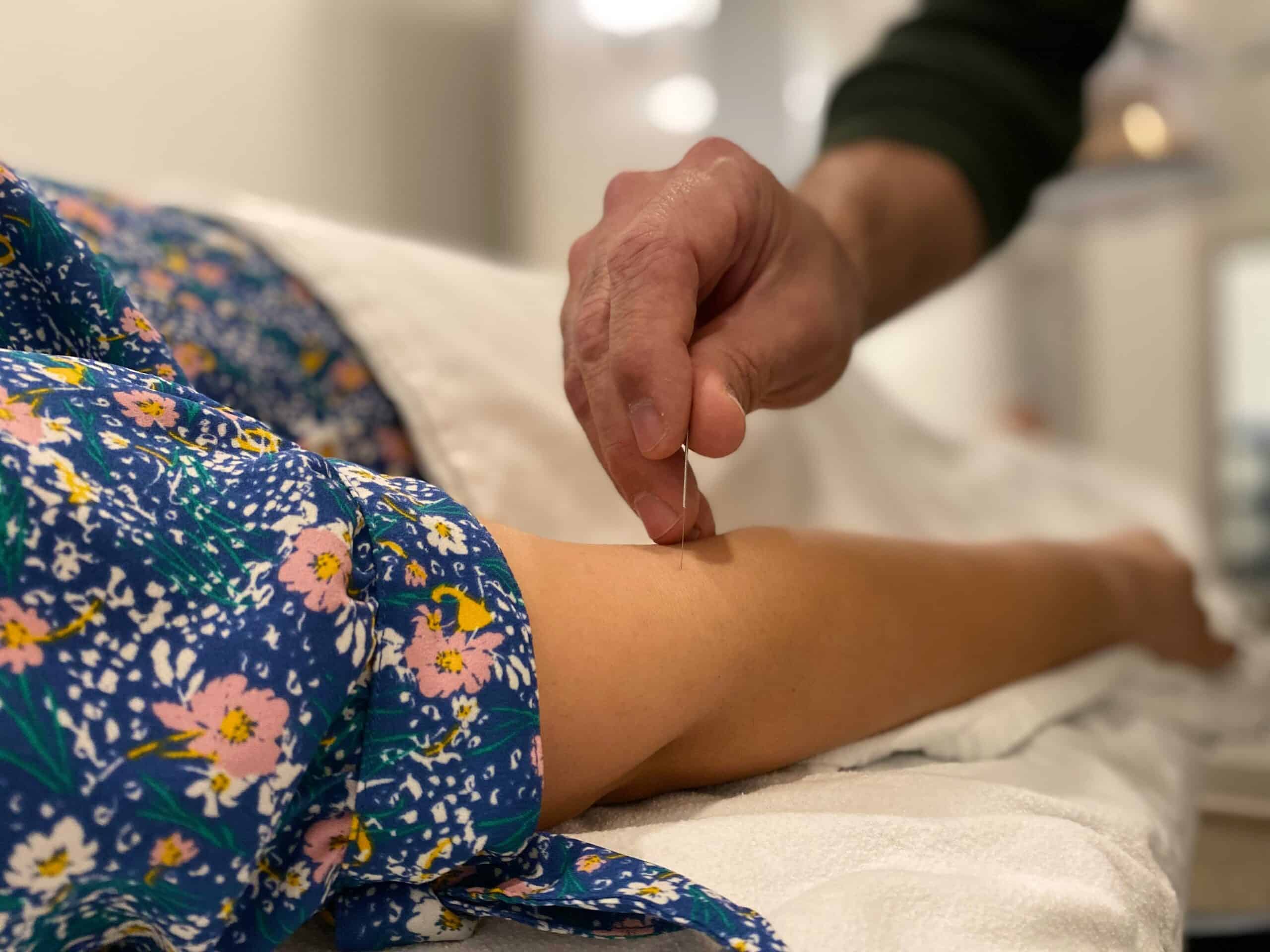 A healthcare professional performing acupuncture on a patient's arm, which can be a treatment option for managing pain associated with conditions like endometriosis.