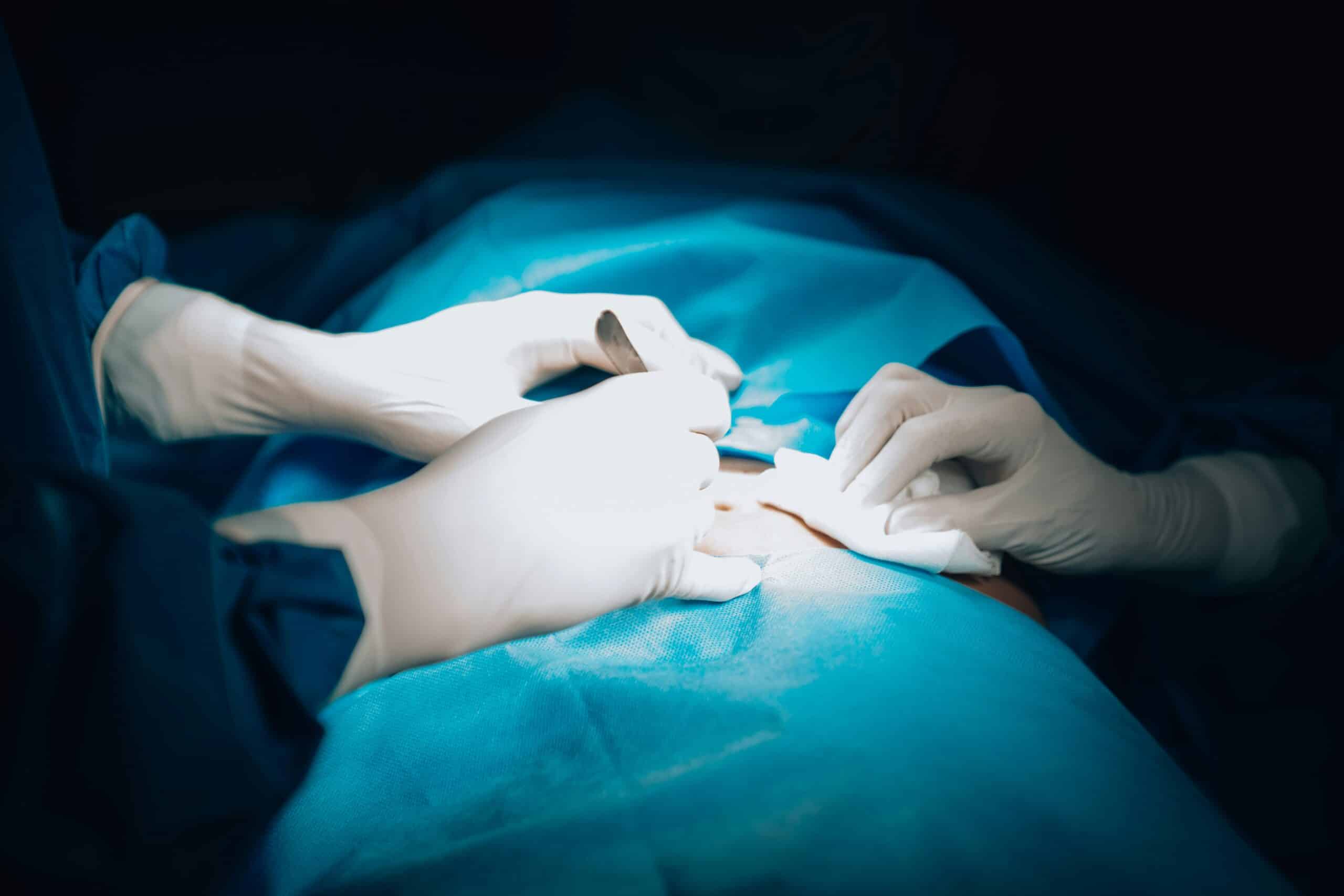 Hysterectomy Insights for Endometriosis Sufferers