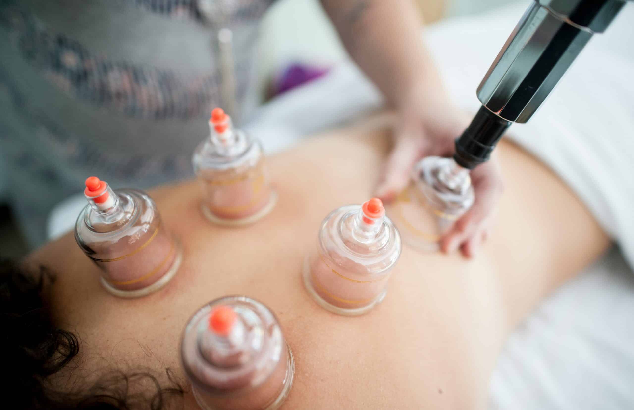 a woman getting acupuncture done - Rachael Haverland Site a woman getting acupuncture done