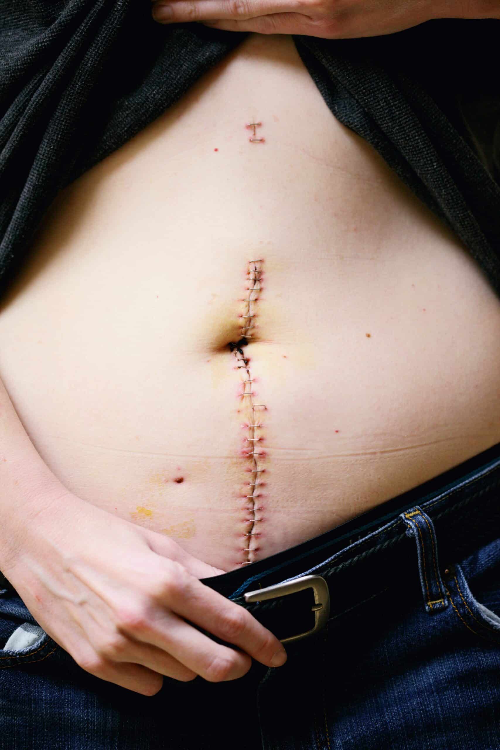 Surgical incision on abdomen with stitches, illustrating recovery process post-endometriosis excision surgery.