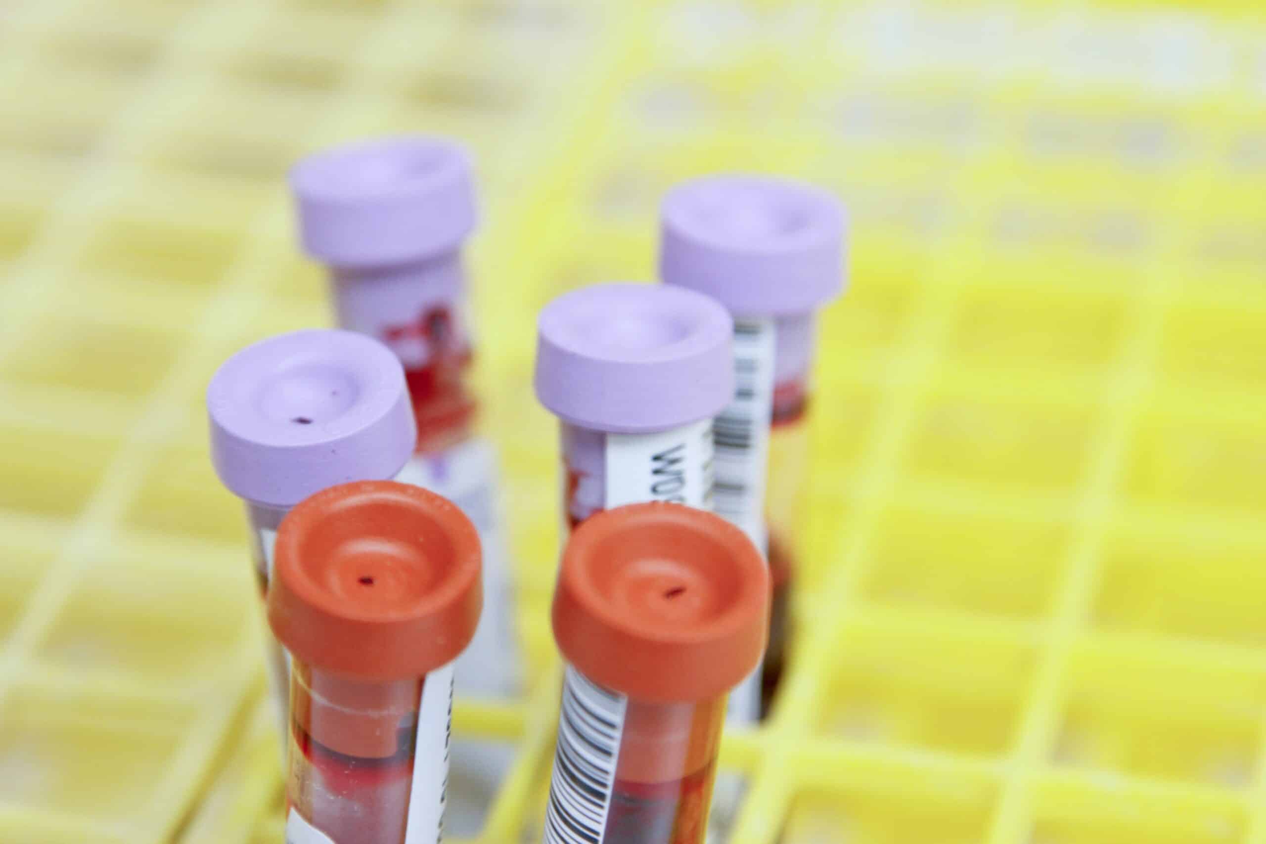 a tray of blood test samples