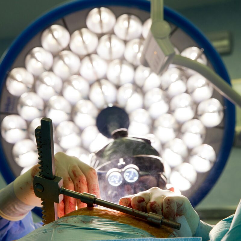 Laparoscopic Surgery for Endometriosis