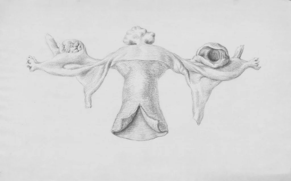 Diagram comparing Stage I through Stage IV endometriosis