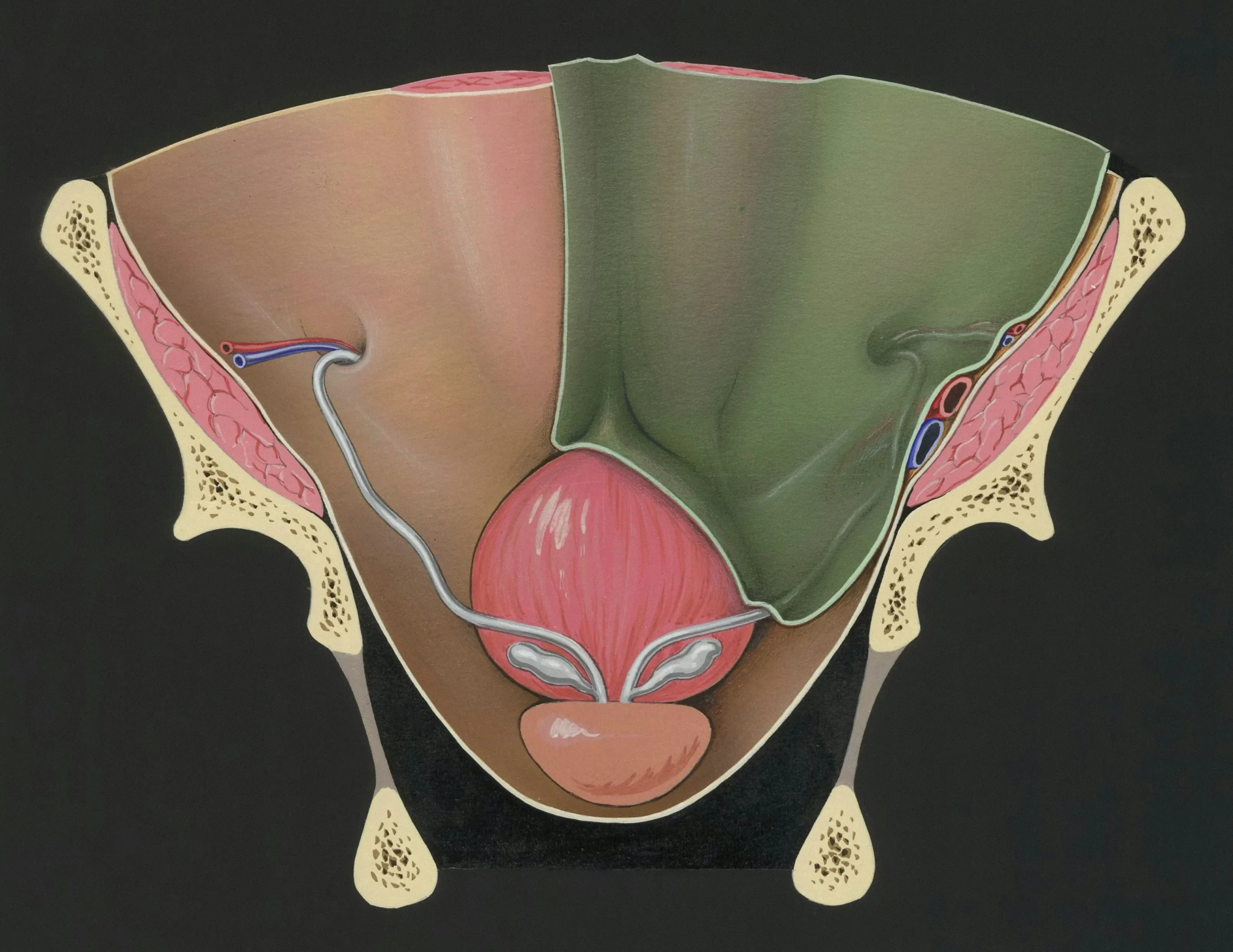 Medical illustration showing endometriosis affecting the reproductive organs